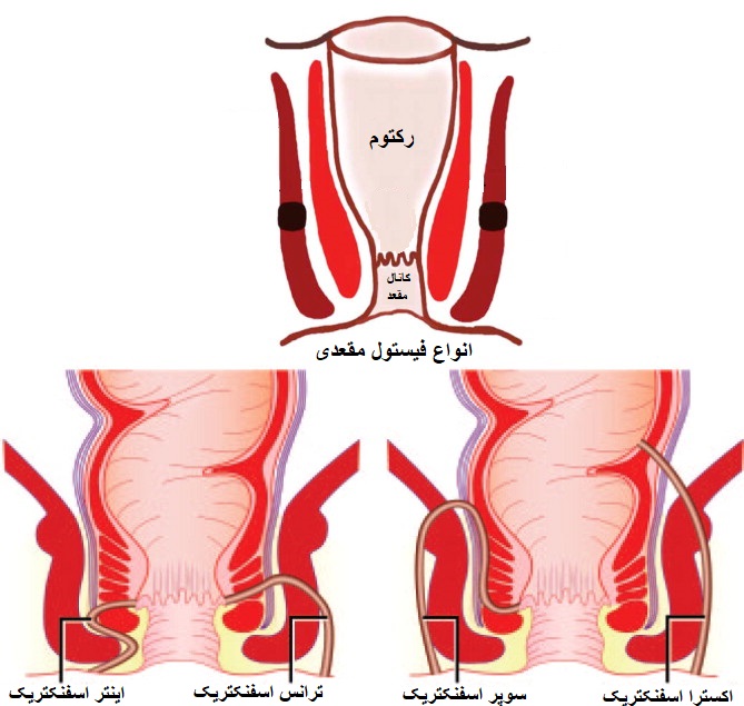 انواع فیستول مقعدی و عوامل تشدید کننده و راه های پیشگیری از این بیماری