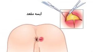 آبسه مقعد چیست؟ علائم تشخیص این بیماری – روش های درمان و پیشگیری از ابتلا به فیستول