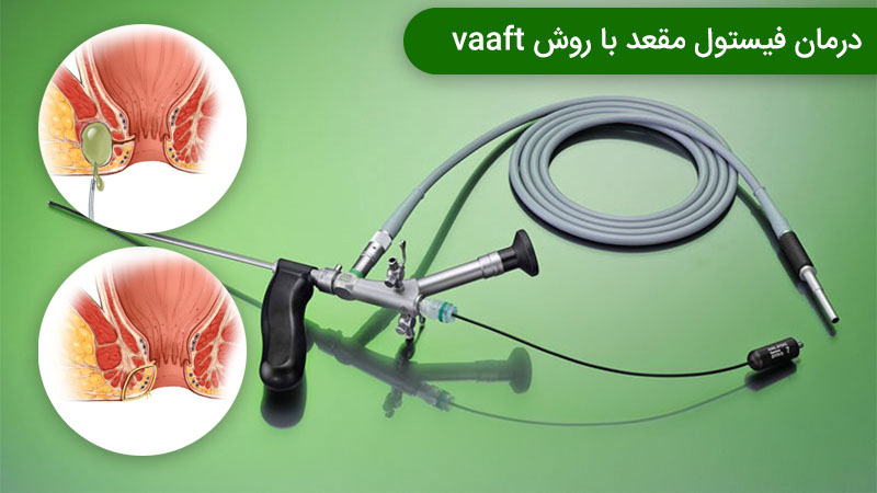 درمان فیستول با VAAFT