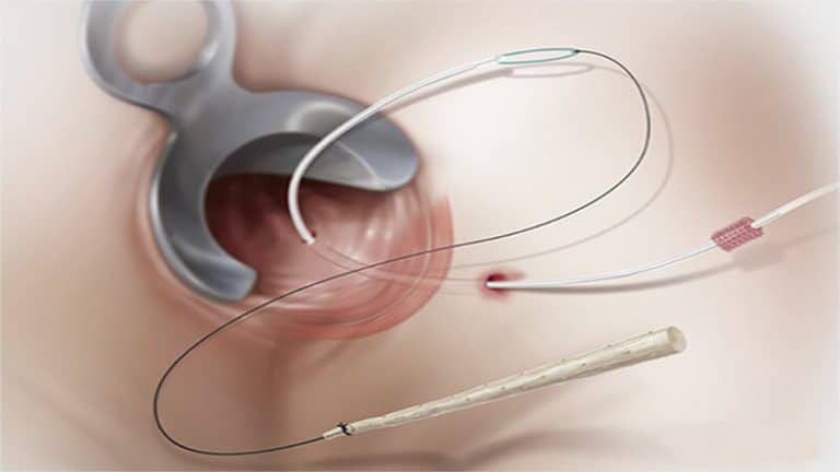 درمان فیستول مقعدی با جراحی