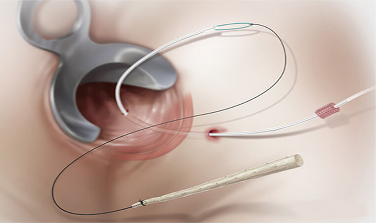 عکس درمان فیستول مقعد با جراحی