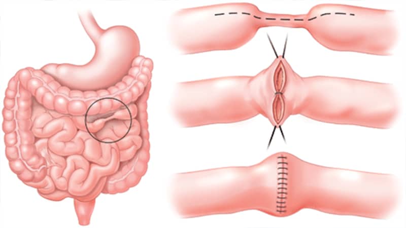 [تصویر:  Crohns-surgery.jpg]