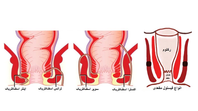 انواع فیستول