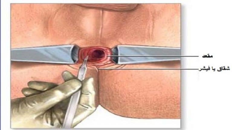  درمان شقاق یا فیشر مقعدی با لیزر بدون خونریزی و روش های عمل جراحی