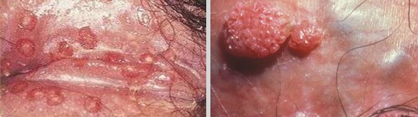 عکس زگیل تناسلی کم خطر در زنان