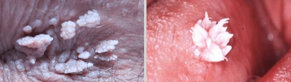 عکس زگیل تناسلی کم خطر در زنان