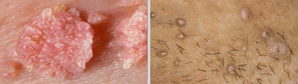 عکس زگیل تناسلی کم خطر در زنان