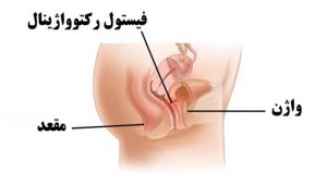 درمان فیستول در زنان (واژن)؛ عکس فیستول وزیکو واژینال