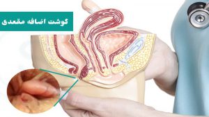 گوشت اضافه مقعدی ؛ درمان با لیزر و علت زائده گوشتی