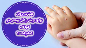 زگیل کودکان (دست، پا، دهان و بدن)؛ درمان، علت و علائم