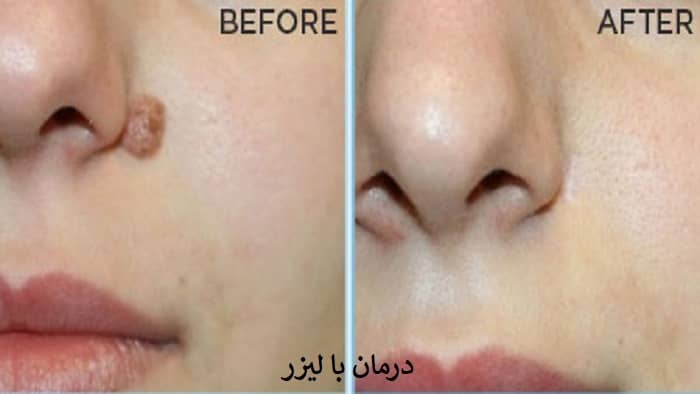 تصویر قبل و بعداز درمان زگیل صورت با لیزر