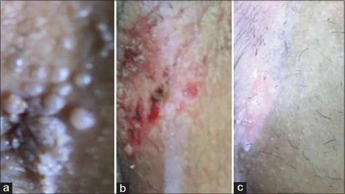 عکس زگیل تناسلی کم خطر در زنان