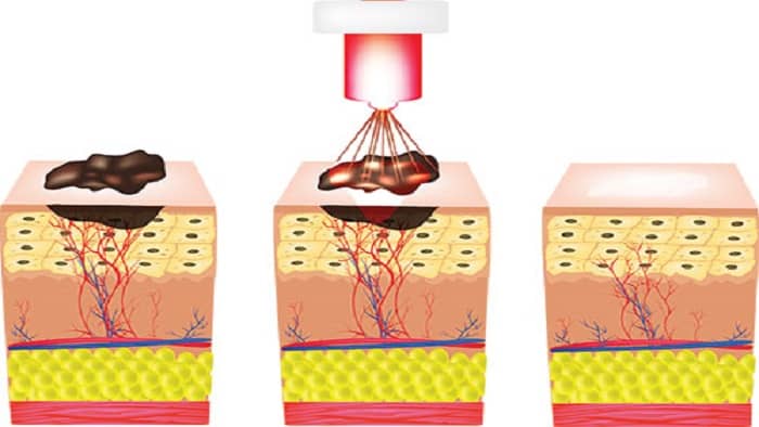 عکس زگیل تناسلی کم خطر در زنان