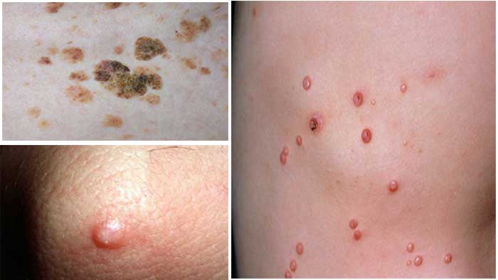 عکس زگیل تناسلی کم خطر در زنان