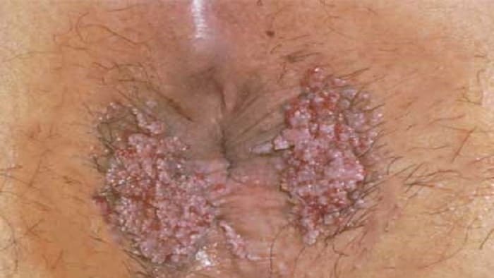 عکس زگیل تناسلی کم خطر در زنان