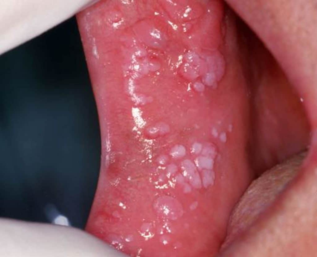 تشخیص زگیل تناسلی در دهان و گلو