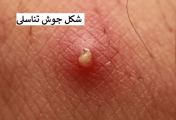 عکس زگیل تناسلی کم خطر در زنان