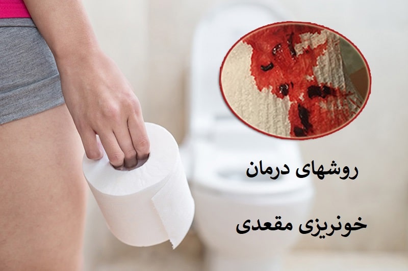 درمان خونریزی مقعدی هنگام دفع مدفوع