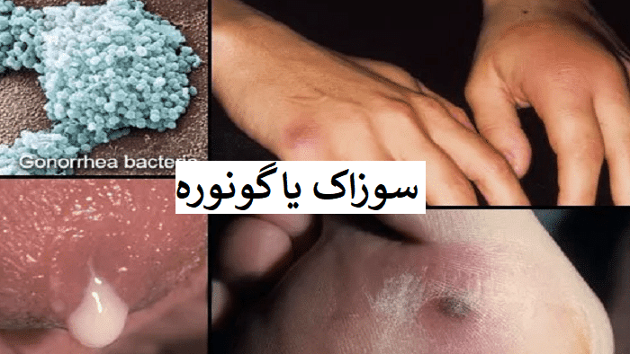 عکس زگیل تناسلی کم خطر در زنان