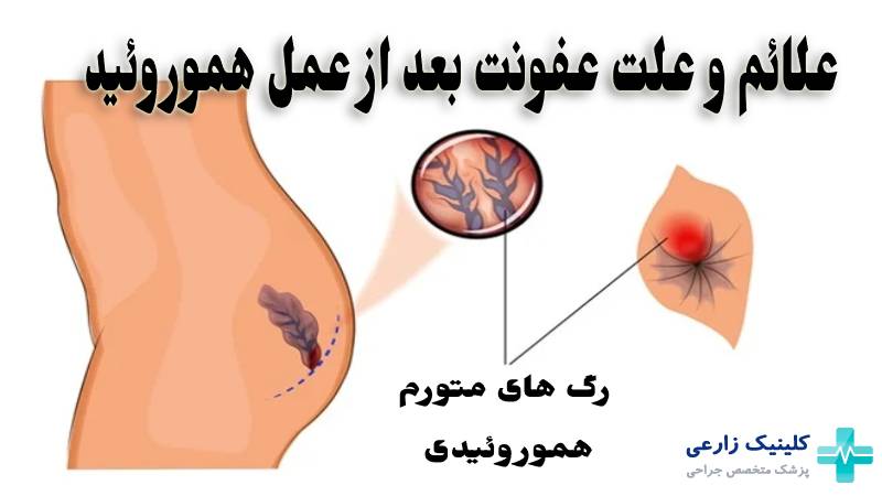 چه زمانی بواسیر نیاز به جراحی / عمل دارد؟