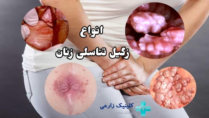 عکس زگیل تناسلی کم خطر در زنان