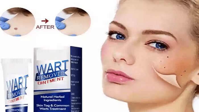 درمان زگیل صورت در طب سنتی + پماد زگیل صورت