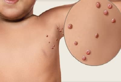 زگیل های زیر بغل بچه