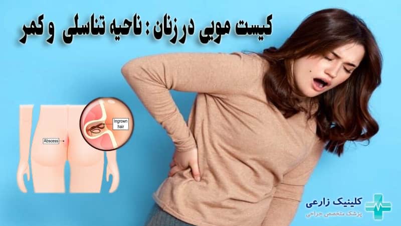 کیست مویی در ناحیه تناسلی زنان