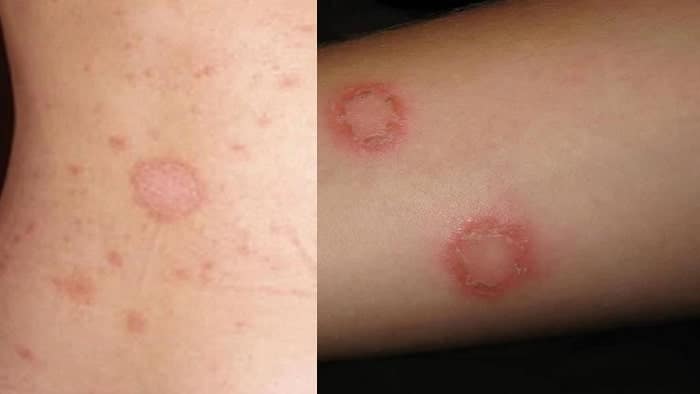 عکس قارچ پوستی