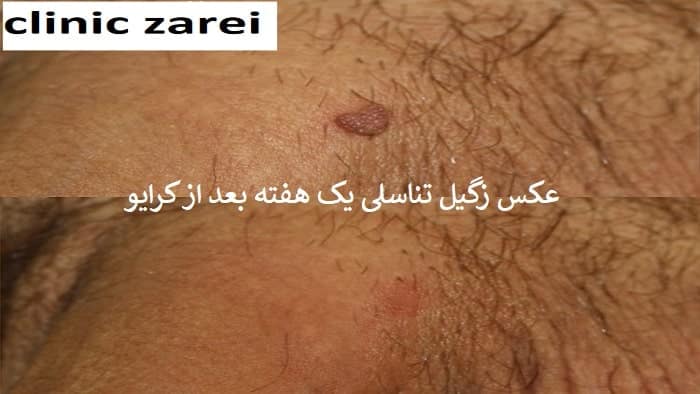 عکس زگیل های تناسلی یک هفته بعد از کرایو