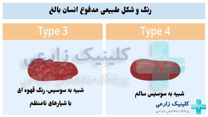 شکل مدفوع نرمال و طبیعی