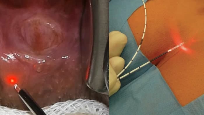 عکس درمان خانگی زخم مقعدی در اثر رابطه