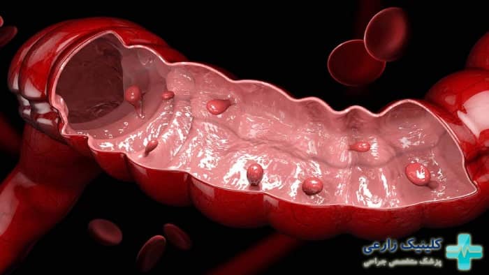 عکس پولیپ روده