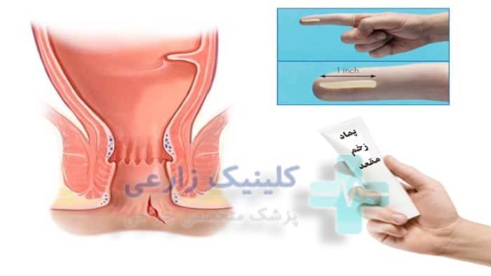 عکس پماد برای درمان زخم مقعدی بزرگسالان