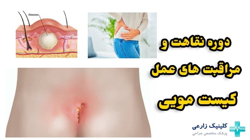 دوران نقاهت بعد از عمل کیست مویی | مرقبتهای بعد عمل