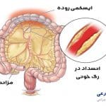ایسکمی مزانتر روده چیست | علائم و درمان قطعی| عوارض خطرناک