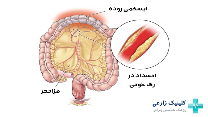 ایسکمی مزانتر روده چیست | علائم و درمان قطعی| عوارض خطرناک