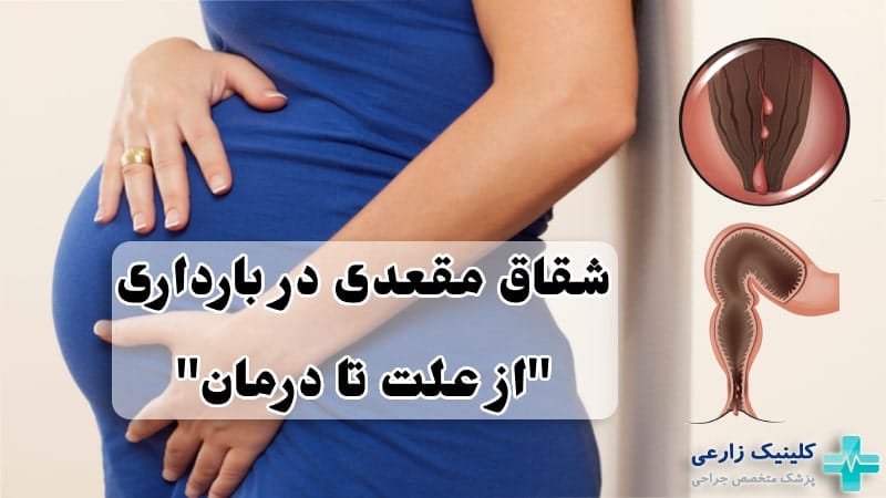 شقاق در بارداری | دلایل، علائم، عوارض و درمان شقاق حاملگی