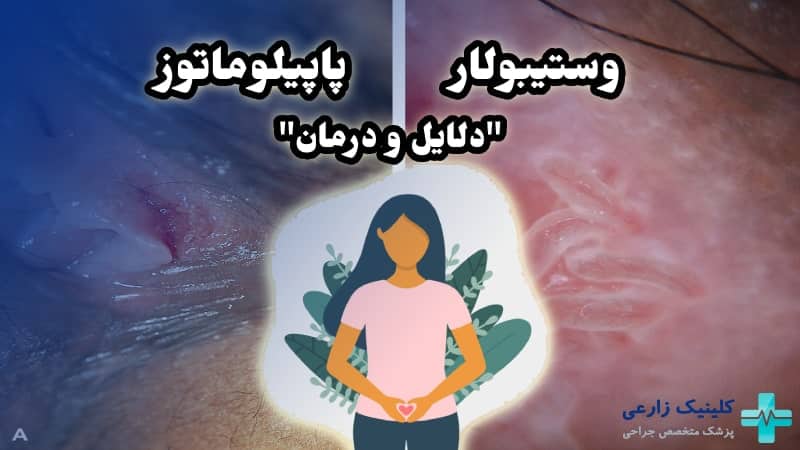 وستیبولار پاپیلوماتوز چیست | درمان و دلایل پاپول مرواریدی