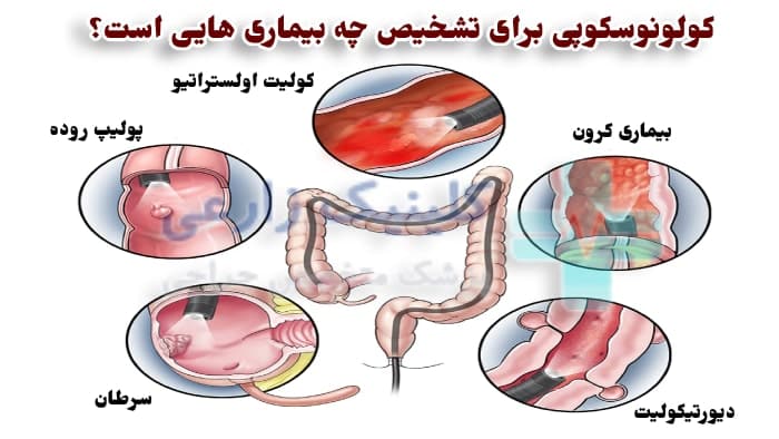 چه زمانی باید کولونوسکوپی کرد+فیلم عمل کولونوسکوپی