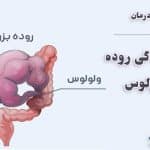 پیچ خوردگی روده (ولولوس) چیست | علائم، دلایل و روشهای درمان