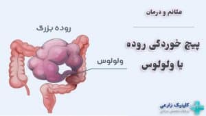 پیچ خوردگی روده (ولولوس) چیست | علائم، دلایل و روشهای درمان