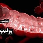 پولیپ روده چیست و از کجا بفهمیم داریم | علائم خطرناک و درمان