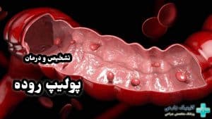 پولیپ روده چیست و از کجا بفهمیم داریم | علائم خطرناک و درمان