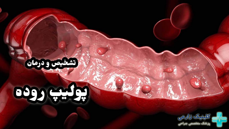 پولیپ روده چیست و از کجا بفهمیم داریم | علائم خطرناک و درمان