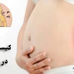 کیست مویی در بارداری باعث سقط میشود؟ “درمان و عوارض”