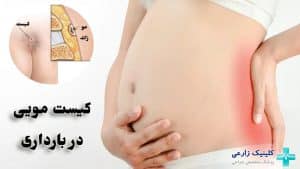 کیست مویی در بارداری باعث سقط میشود؟ “درمان و عوارض”