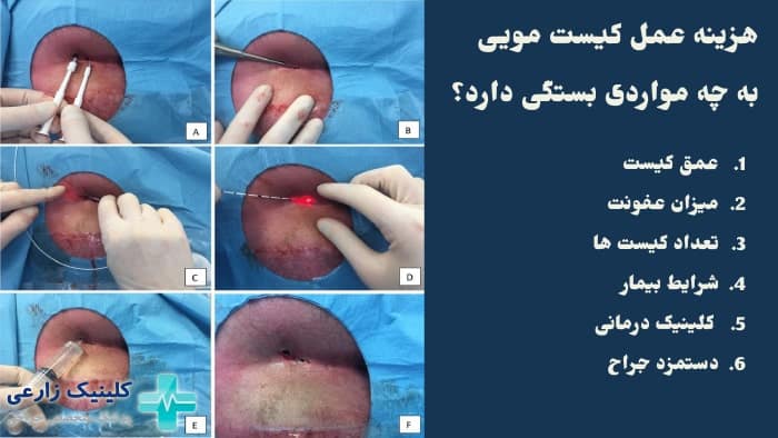 عمل کیست مویی باز (سنتی) بهتر است یا لیزر