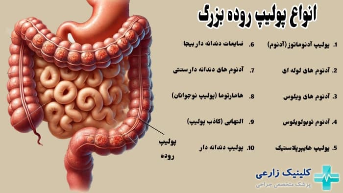 چه نوع پولیپی خطرناک است؟