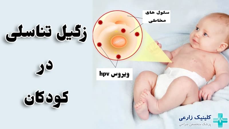 زگیل تناسلی در کودکان به چه علت است؟ “روشهای انتقال و درمان”